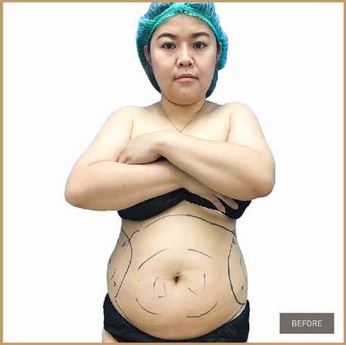 Vaser Liposelection