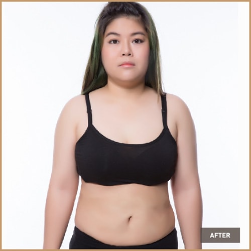 Vaser Liposelection