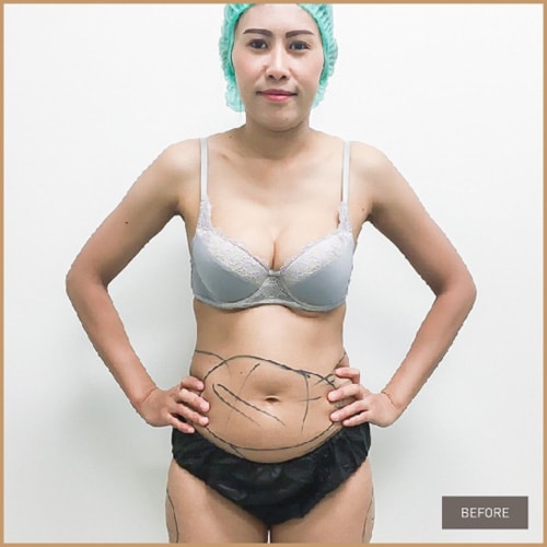 Vaser Liposelection