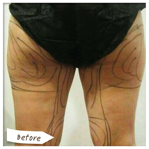 Vaser Liposelection