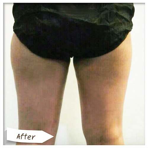 Vaser Liposelection