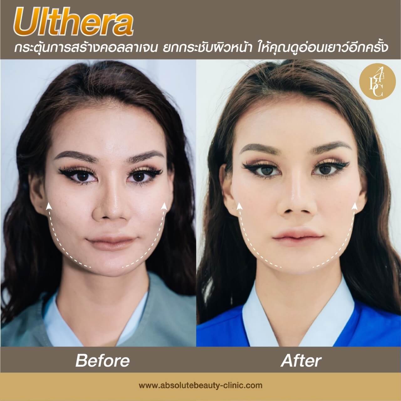 ulthera ยกกระชับใบหน้า